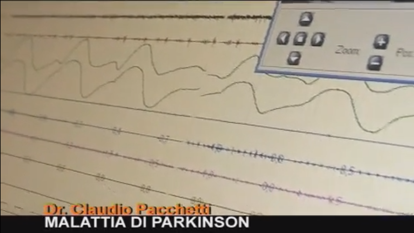 Intervista al dott. Pacchetti, neurologo specializzato nella cura del Parkinson